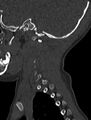 Normal CT cervical spine - pediatric (Radiopaedia 52549-58462 Sagittal bone window 16).jpg