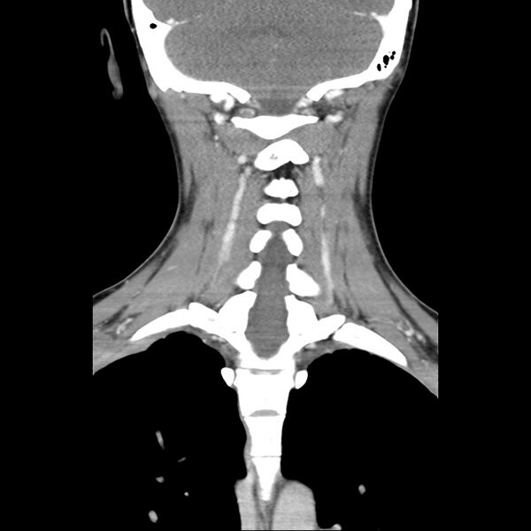 File:Normal CT of the neck (Radiopaedia 14575-14500 Coronal C+ 39).jpg