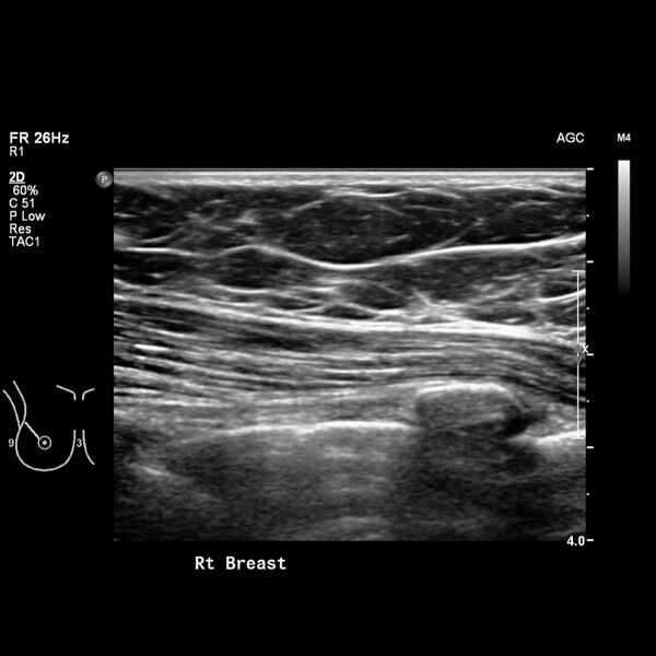 File:Normal breast mammography (tomosynthesis) and ultrasound (Radiopaedia 65325-74354 Right breast 12).jpeg