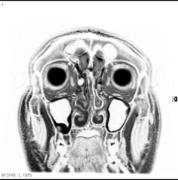 File:Normal coronal brain (Radiopaedia 6676-7910 B 1).jpg