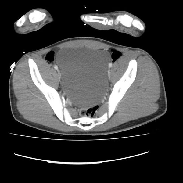File:Normal dual-phase trauma CT chest,abdomen and pelvis (Radiopaedia 48092-52899 A 99).jpg