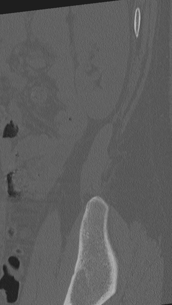 File:Normal lumbar spine CT (Radiopaedia 46533-50986 Sagittal bone window 2).png