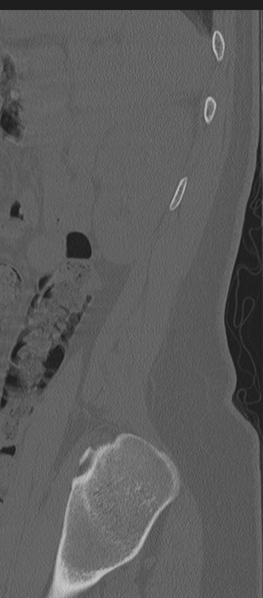 File:Normal lumbosacral CT (Radiopaedia 37923-39867 Sagittal bone window 10).png