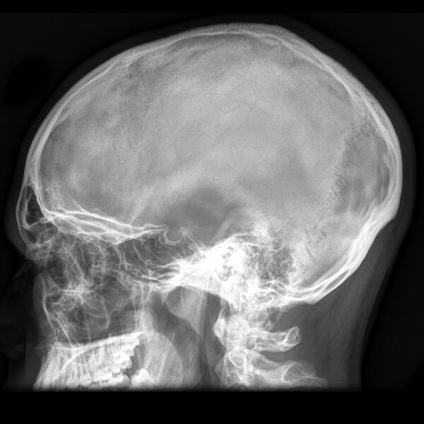 File:Normal skull (Radiopaedia 8301-9144 Lateral 1).jpg