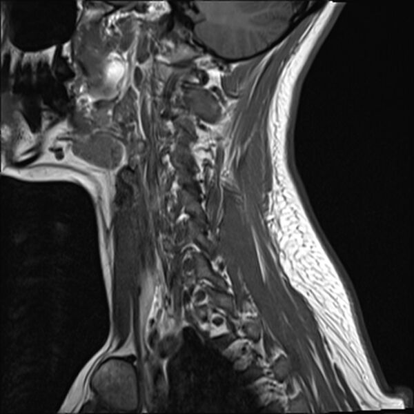 File:Normal trauma cervical spine MRI (Radiopaedia 32130-33071 Sagittal T1 15).jpg