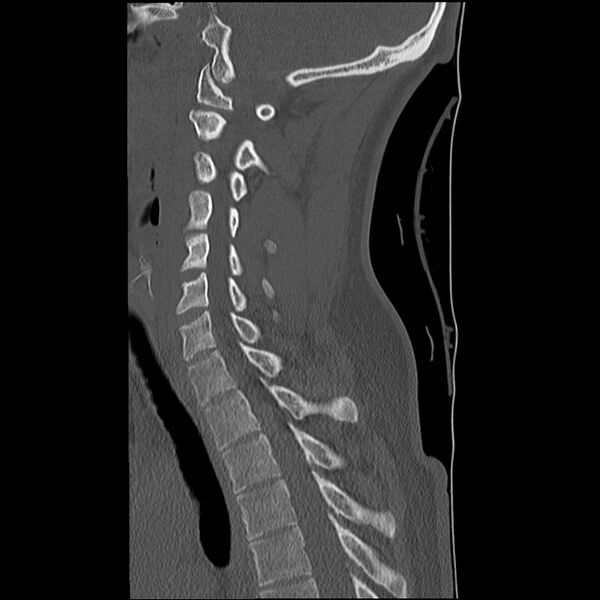 File:Normal trauma spine imaging (Radiopaedia 31753-32686 Sagittal bone window 25).jpg