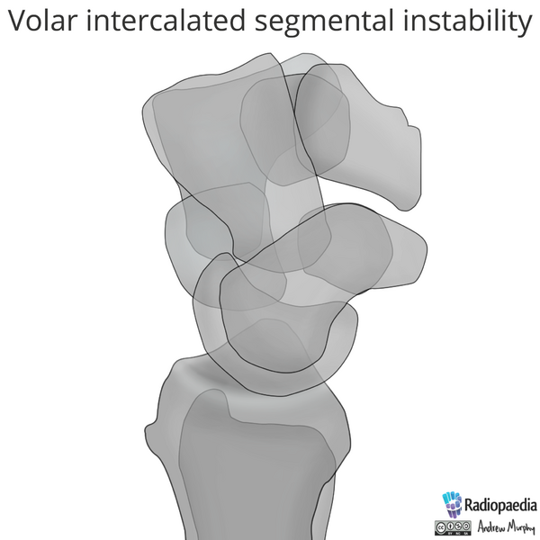 File:Normal wrist alignment, dorsal and volar intercalated segmental instability (illustration) (Radiopaedia 80949-94487 A 3).png