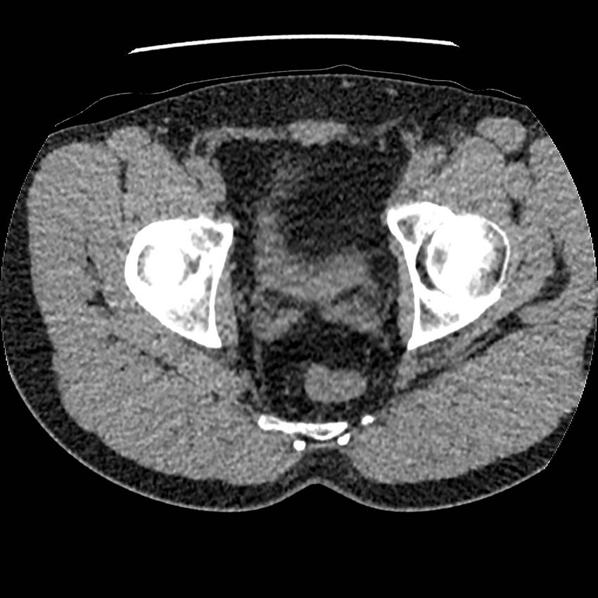 Obstructing ureteric calculus and ureteric anatomy (Radiopaedia 62730-71042 Axial non-contrast 157).jpg