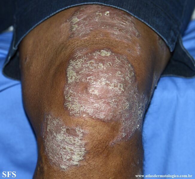 File:Psoriasis (Dermatology Atlas 156).jpg