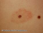See more images of halo naevi. (DermNet NZ lesions-w-meyerson5).jpg