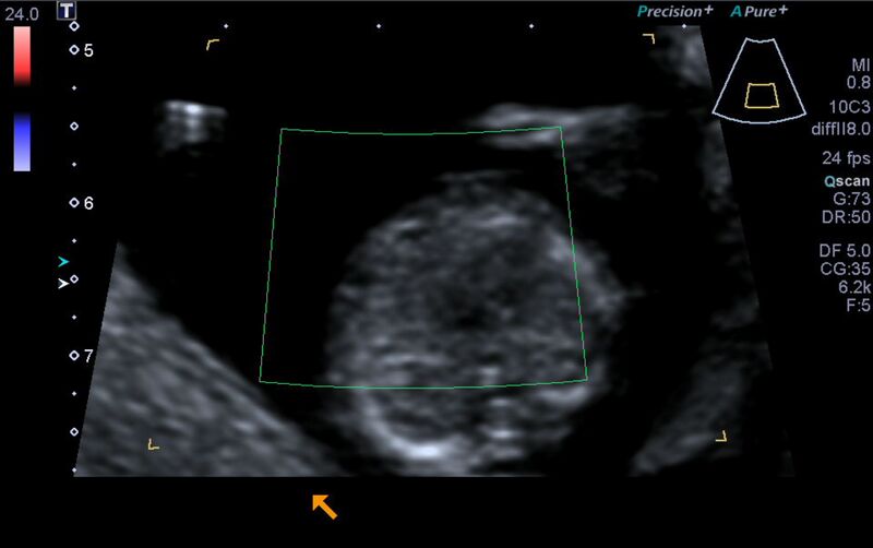 File:1st trimester nuchal-morphology ultrasound (Radiopaedia 44706-48477 Heart views cine with colour 98).jpg