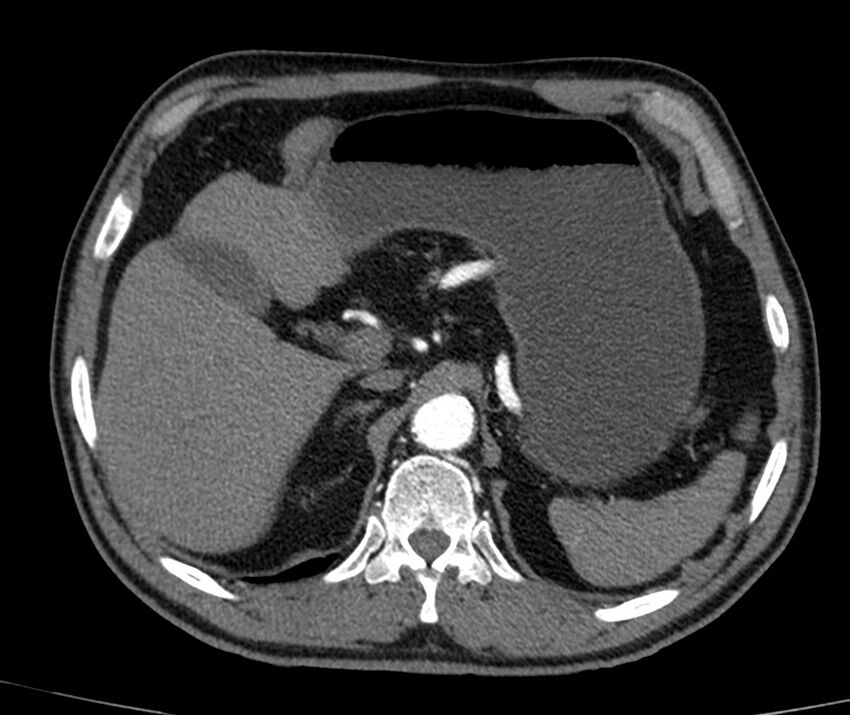 Abdominal aortic aneurysm (Radiopaedia 22421-22458 C+ arterial phase 10).jpg
