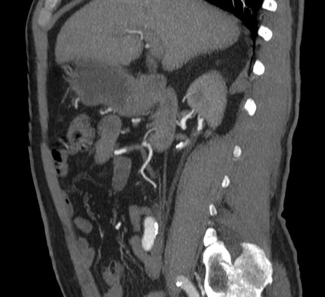 File:Abdominal aortic aneurysm (Radiopaedia 22421-22458 D 11).jpg