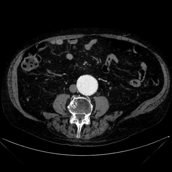 File:Abdominal aortic aneurysm (Radiopaedia 25855-26001 Axial C+ arterial phase 77).jpg