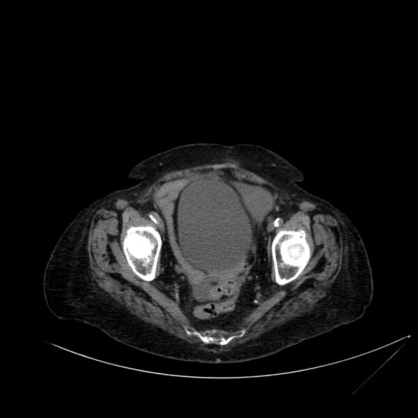 File:Abdominal aortic aneurysm - impending rupture (Radiopaedia 19233-19246 Axial non-contrast 110).jpg