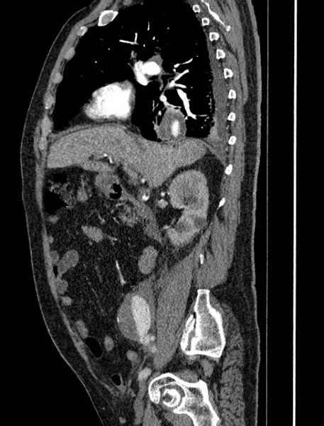 File:Abdominal aortic aneurysm rupture (Radiopaedia 54179-60362 Sagittal C+ arterial phase 14).jpg