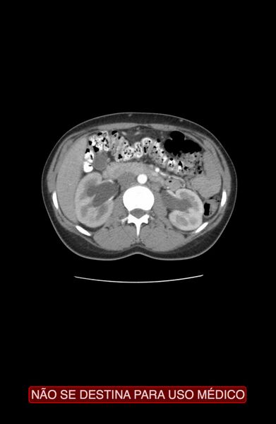 File:Abdominal desmoid tumor (Radiopaedia 44024-47540 Axial C+ arterial phase 6).jpg