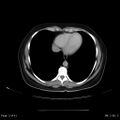 Abdominal wall endometriosis (Radiopaedia 25723-25885 Axial C+ portal venous phase 2).jpg