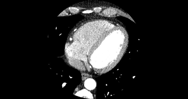 File:Aberrant left main coronary artery (ALMCA) arising from the right sinus with interarterial course (Radiopaedia 63251-71814 Axial C+ arterial phase 140).JPG