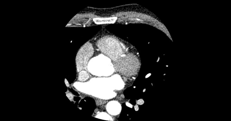 File:Aberrant left main coronary artery (ALMCA) arising from the right sinus with interarterial course (Radiopaedia 63251-71814 Axial C+ arterial phase 66).JPG