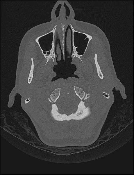 File:Aberrant right internal carotid artery (Radiopaedia 65191-74198 Axial non-contrast 6).jpg