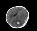 Abusive head trauma (Radiopaedia 70205-80252 Axial non-contrast 21).jpg