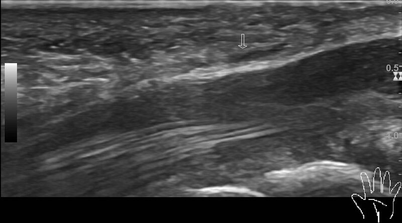 File:Accessory abductor digiti minimi muscle (hand) (Radiopaedia 85395-101015 Long and short axis images 4).jpg