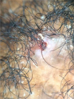Tufted hairs with an area of loss of follicular ostia