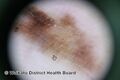 Acral lentiginous melanoma dermoscopy (DermNet NZ alm-dermoscopy-6).jpg