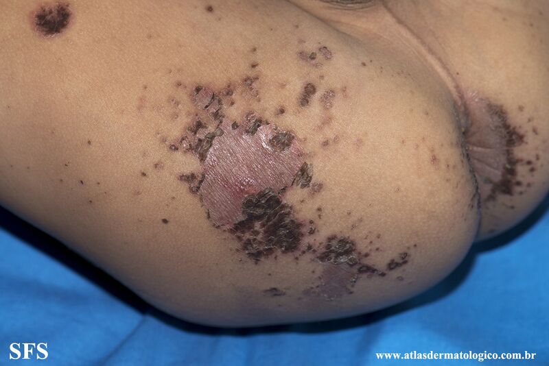 File:Acrodermatitis Enteropathica (Dermatology Atlas 64).jpg