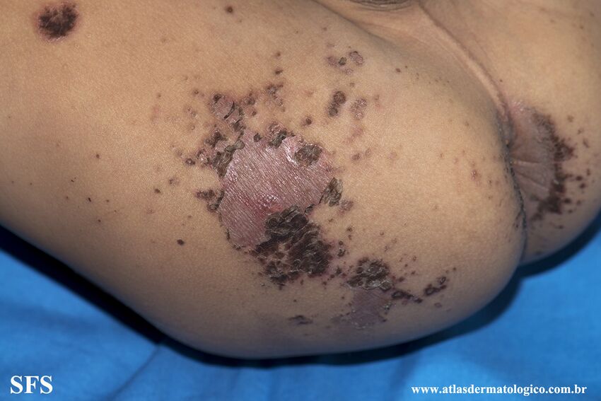 Acrodermatitis Enteropathica (Dermatology Atlas 64).jpg