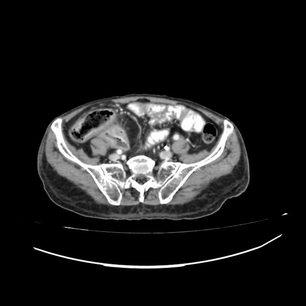 File:Acute-on-chronic Crohn disease with enteroenteric fistula (Radiopaedia 66686-75987 B 44).jpg