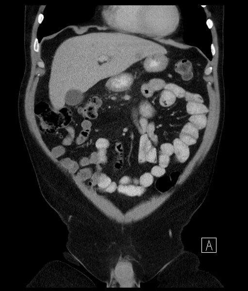 File:Acute-on-chronic pancreatitis (Radiopaedia 67286-76656 Coronal C+ portal venous phase 27).jpg