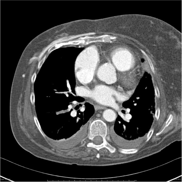 File:Acute-on-chronic pulmonary emboli (Radiopaedia 27925-28169 C+ CTPA 45).jpg