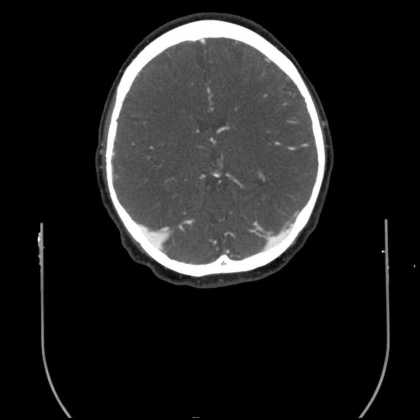 Acute M1 occlusion with ischemic penumbra (CT perfusion) (Radiopaedia 71897-82344 Axial C+ arterial phase thins 43).jpg