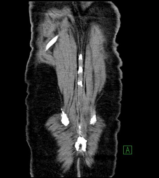 File:Acute arterial mesenteric ischemia (Radiopaedia 78238-90828 Coronal C+ portal venous phase 84).jpg