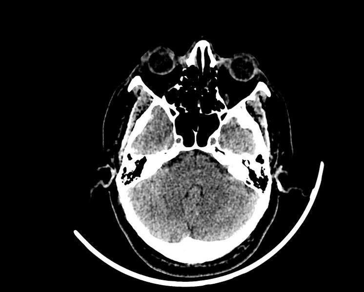 File:Acute cerebral infarct (Radiopaedia 35604-37123 Axial non-contrast 24).jpg