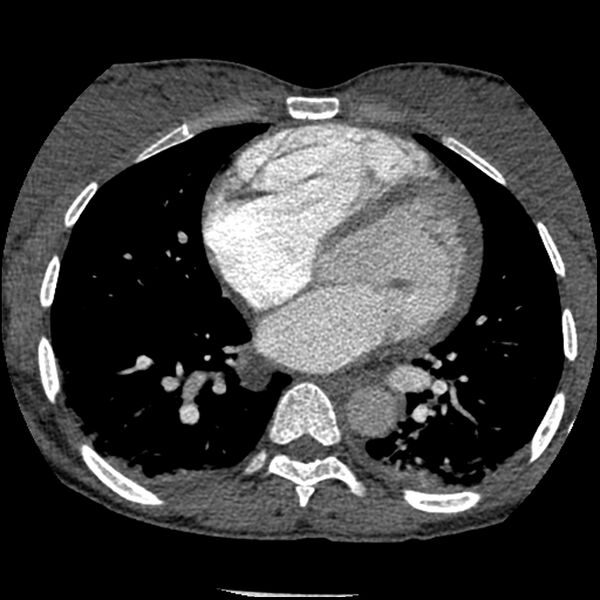 File:Acute chest syndrome - sickle cell disease (Radiopaedia 42375-45499 Axial C+ CTPA 114).jpg