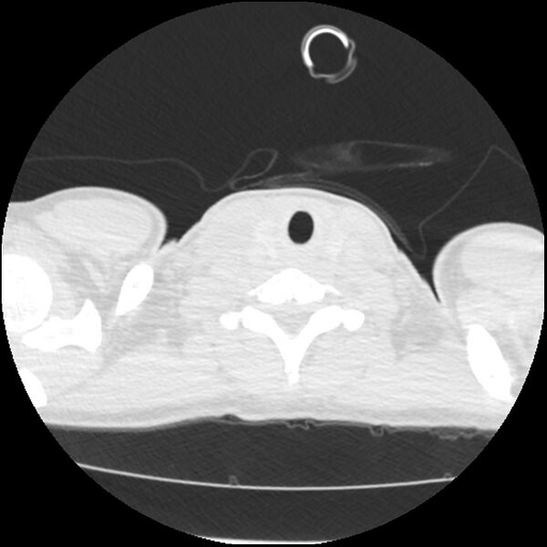 File:Acute chest syndrome - sickle cell disease (Radiopaedia 42375-45499 Axial lung window 2).jpg