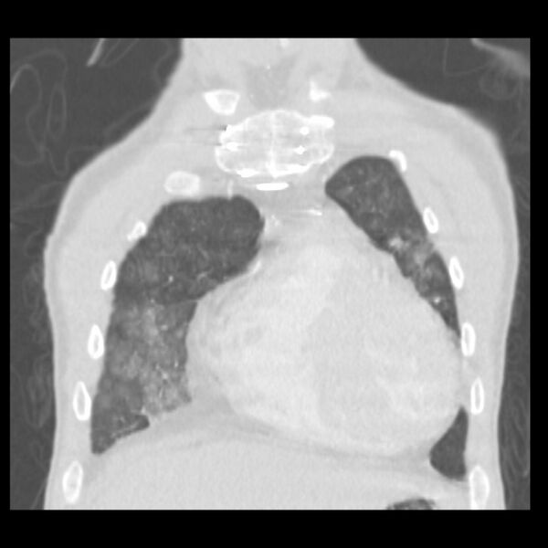 File:Acute diffuse alveolar hemorrhage (Radiopaedia 41323-44158 Coronal lung window 6).jpg