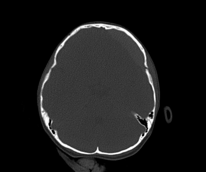File:Acute epidural hematoma (Radiopaedia 63659-72335 Axial bone window 10).jpg