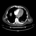 Acute heart failure (CT) (Radiopaedia 79835-93075 Axial C+ arterial phase 37).jpg