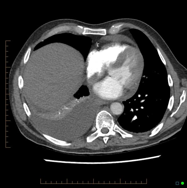 File:Acute hemorrhage into adrenal metastasis from NSCLC (Radiopaedia 43135-46429 Axial C+ CTPA 3).jpg