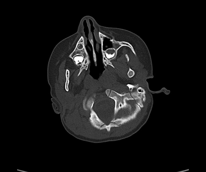 File:Acute hemorrhagic contusion (Radiopaedia 63660-72336 Axial bone window 9).jpg