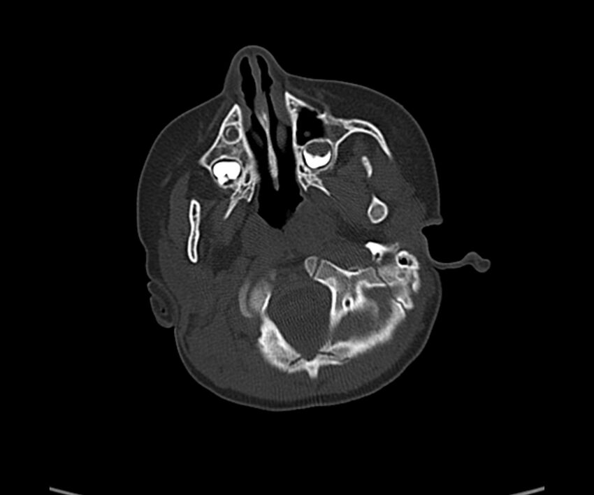 Acute hemorrhagic contusion (Radiopaedia 63660-72336 Axial bone window 9).jpg