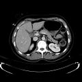 Acute myocardial infarction in CT (Radiopaedia 39947-42415 Axial C+ portal venous phase 41).jpg