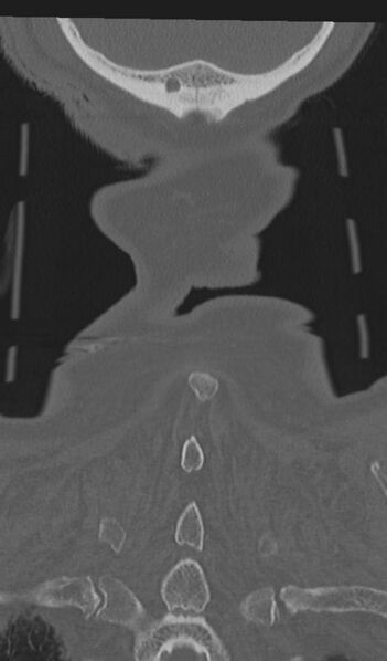 File:Acute on chronic subdural hematoma and thoracic vertebral injury in a multitrauma patient (Radiopaedia 31698-32619 Coronal bone window 68).jpg