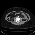 Acute pancreatitis - Balthazar C (Radiopaedia 26569-26714 Axial C+ arterial phase 51).jpg
