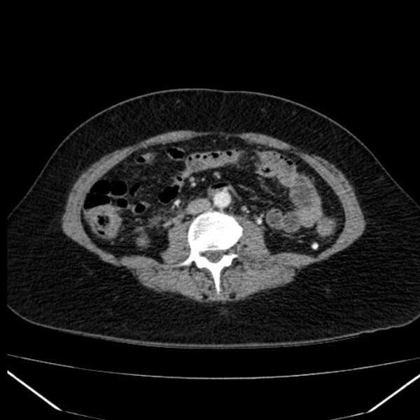 File:Acute pancreatitis - Balthazar C (Radiopaedia 26569-26714 Axial C+ arterial phase 51).jpg