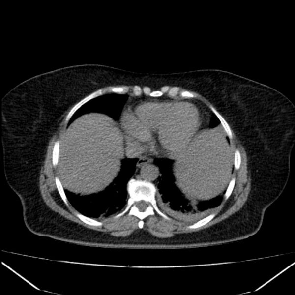 File:Acute pancreatitis - Balthazar C (Radiopaedia 26569-26714 Axial non-contrast 13).jpg